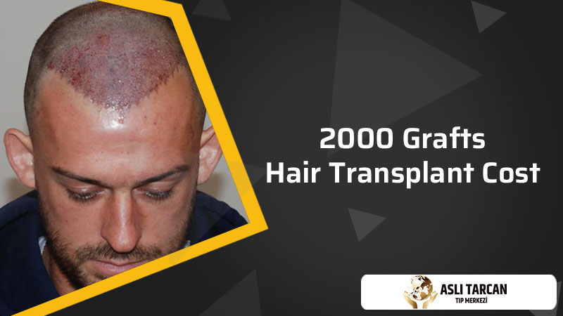 2000 Grafts Hair Transplant Cost