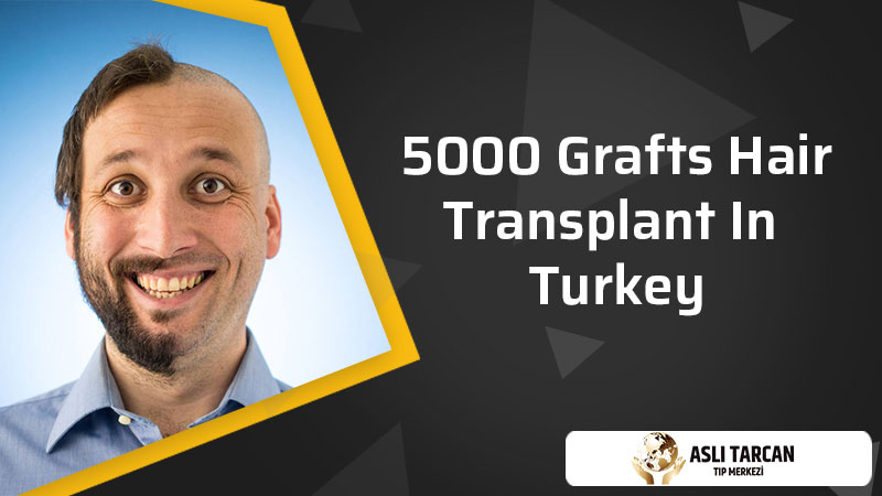 5000 Grafts Hair Transplant In Turkey
