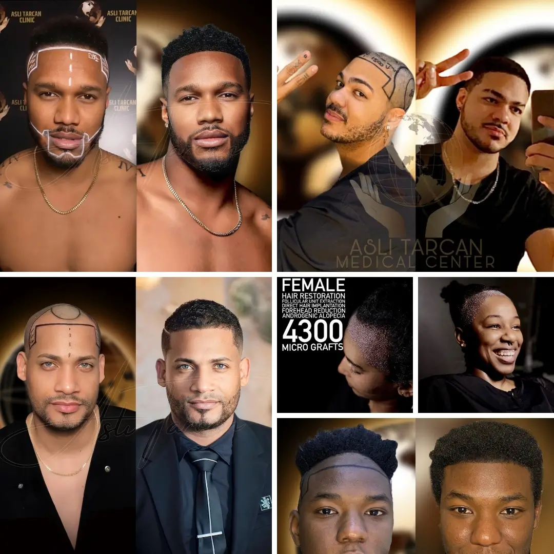 Hair Transplant Before & After