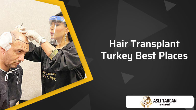 Hair Transplant Turkey Best Places