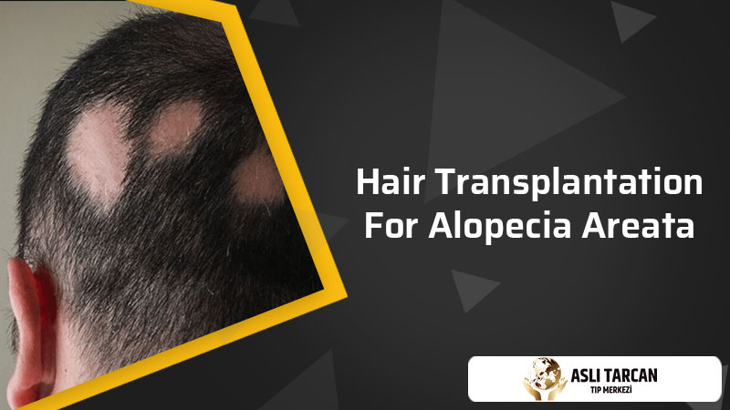 Hair Transplantation For Alopecia Areata