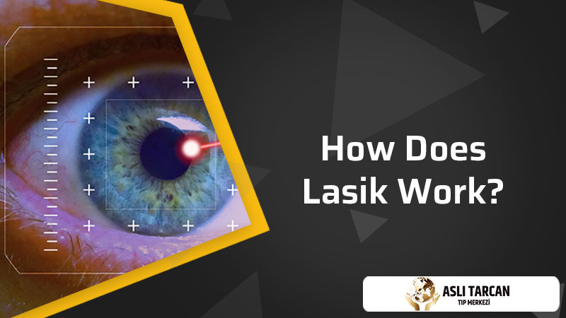 How Does Lasik Work?
