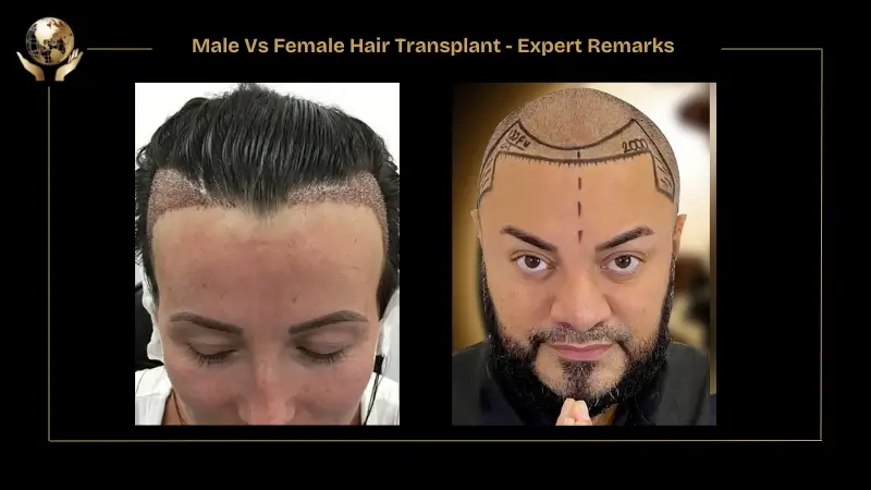Female Hair Transplant Success Rate