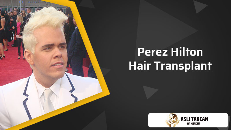 Perez Hilton Hair Transplant