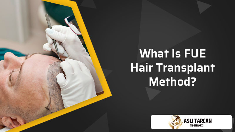 What Is FUE Hair Transplant Method?