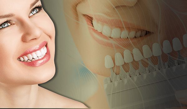 Teeth whitening ( Bleatching )​