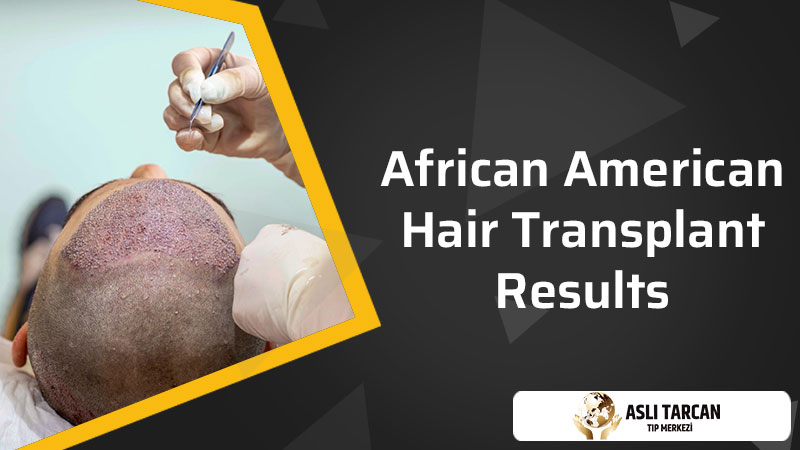 African American Hair Transplant Results