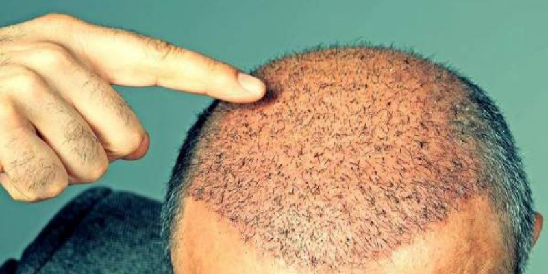 After Hair Transplant Process