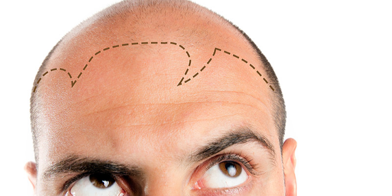 All inclusive hair transplant