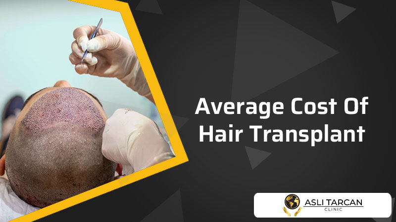 Average Cost Of Hair Transplant