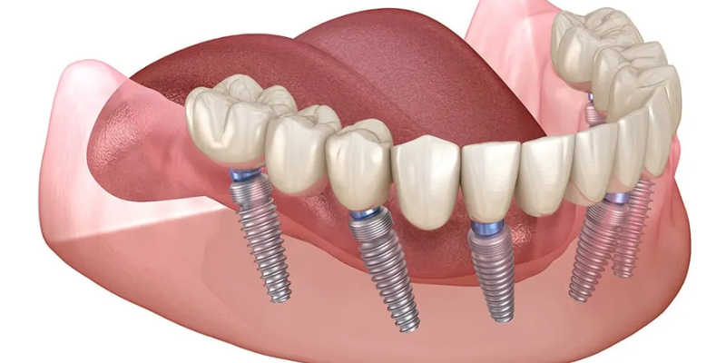 Bad Dental Implants