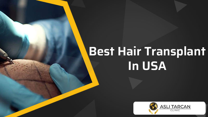 Best Hair Transplant In USA