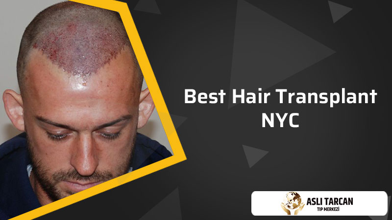 Best Hair Transplant NYC