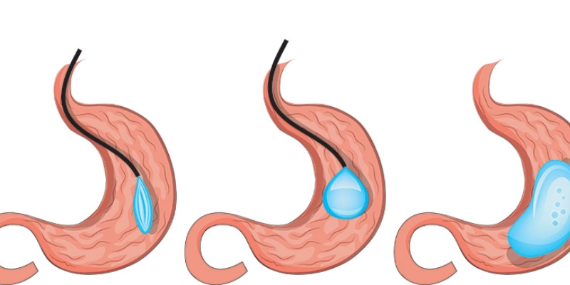 Can a gastric sleeve be redone