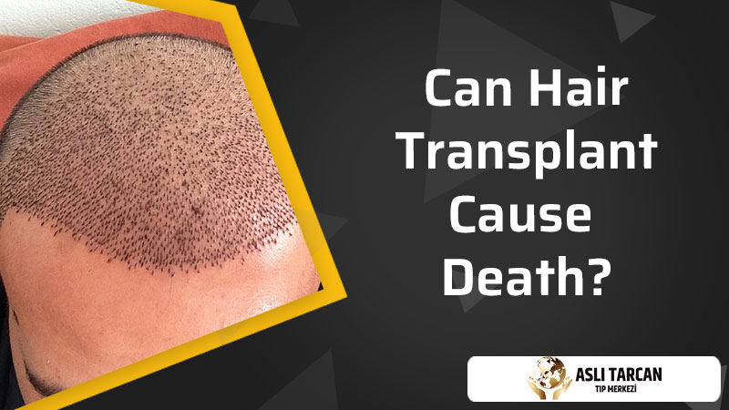 Can Hair Transplant Cause Death?