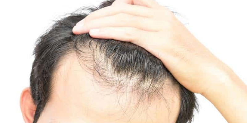 Can I use oil after  hair transplant