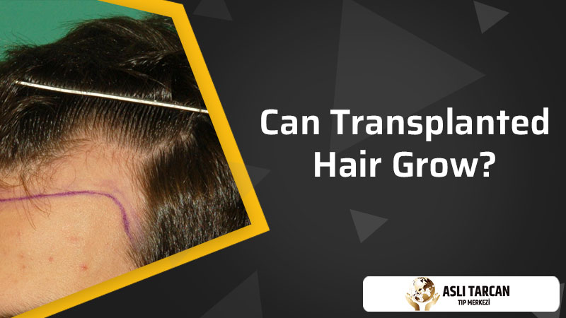 Can Transplanted Hair Grow