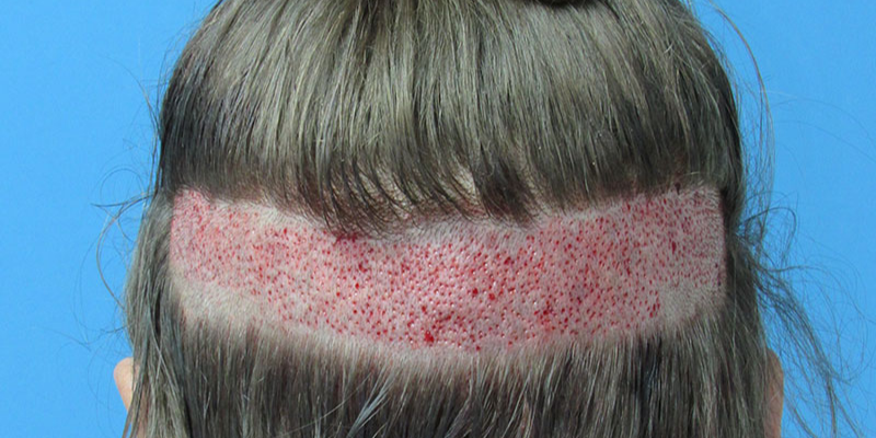 Can You Do A Hair Transplant With Long Hair?