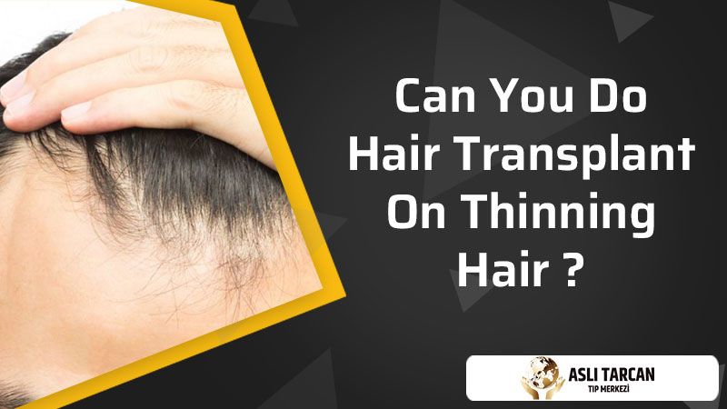 Can You Do Hair Transplant On Thinning Hair | Asli Tarcan Clinic
