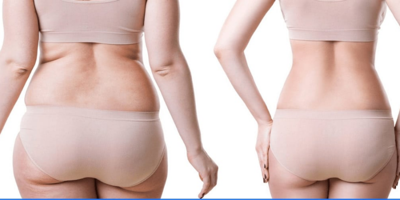 can you gain weight after a gastric sleeve