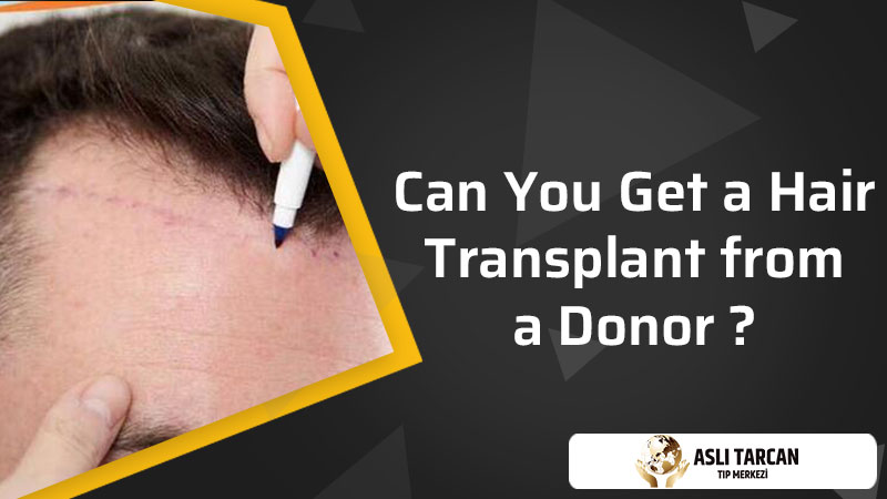 Can You Get a Hair Transplant from a Donor