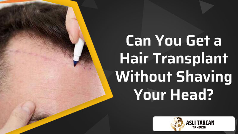 Can You Get a Hair Transplant Without Shaving Your Head