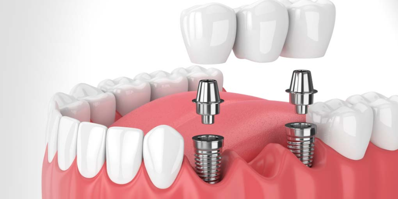 Cost Of Full Mouth Dental Implants