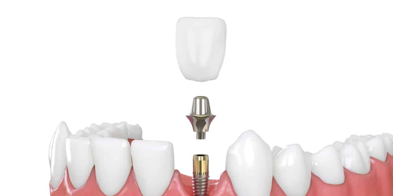 Dental Implants Cost Per Tooth