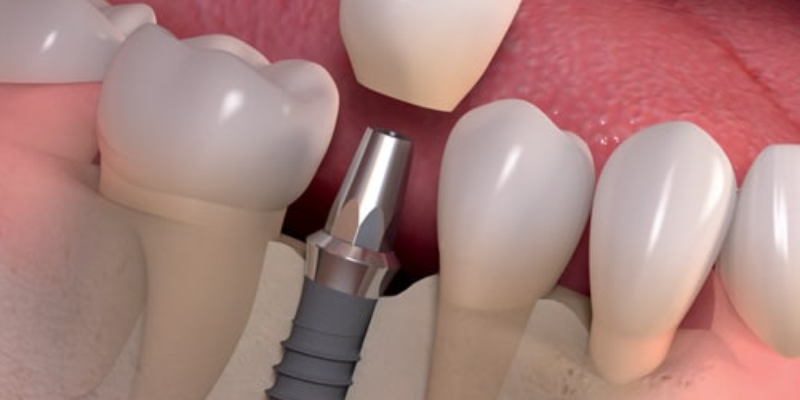 Dental Implants Las Vegas