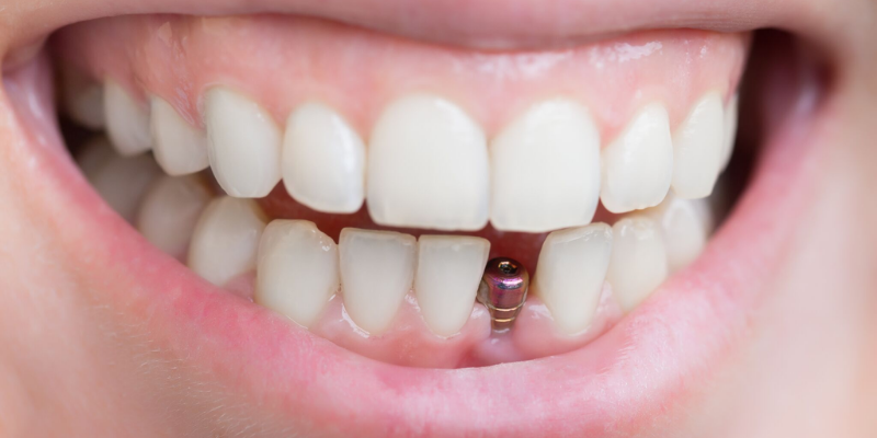 Dental Implants Treatment Procedure