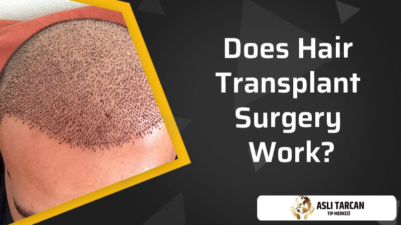 Does Hair Transplant Surgery Work?