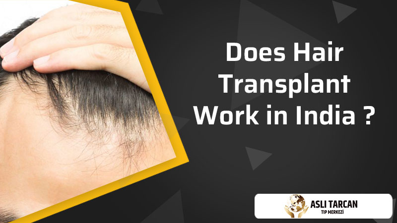 Does Hair Transplant Work in India | Asli Tarcan Clinic