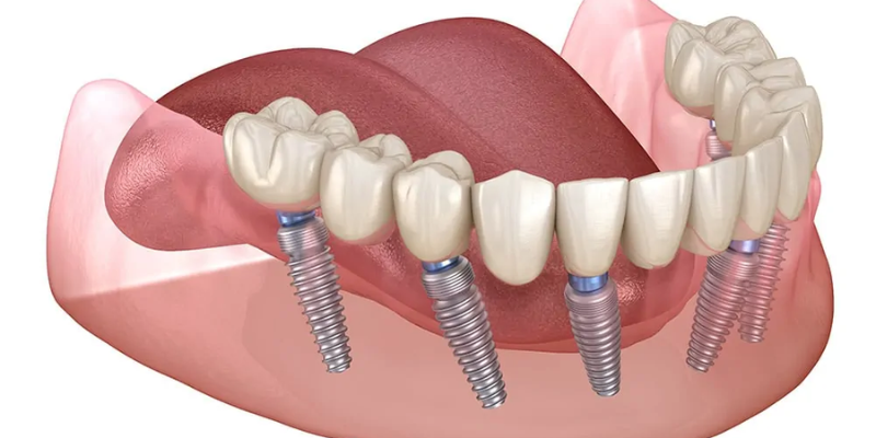 Does Medicare Cover Dental Implants