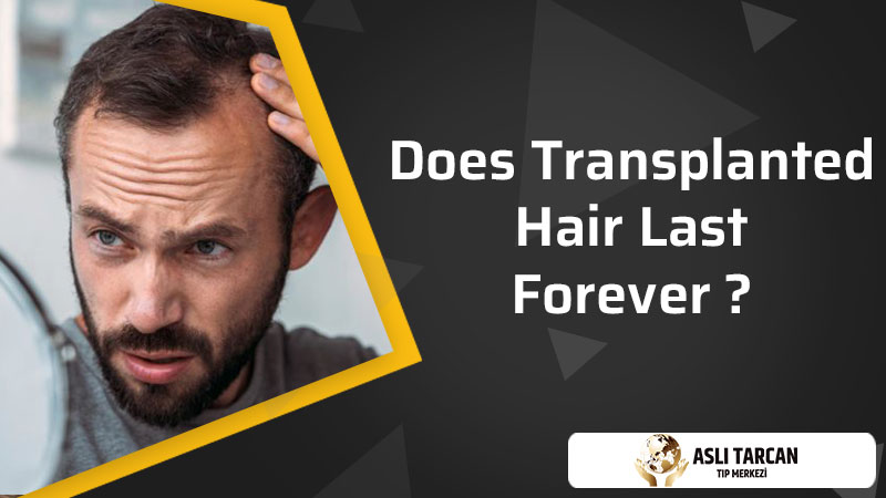 Does Transplanted Hair Last Forever