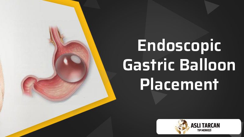 Endoscopic Gastric Balloon Placement