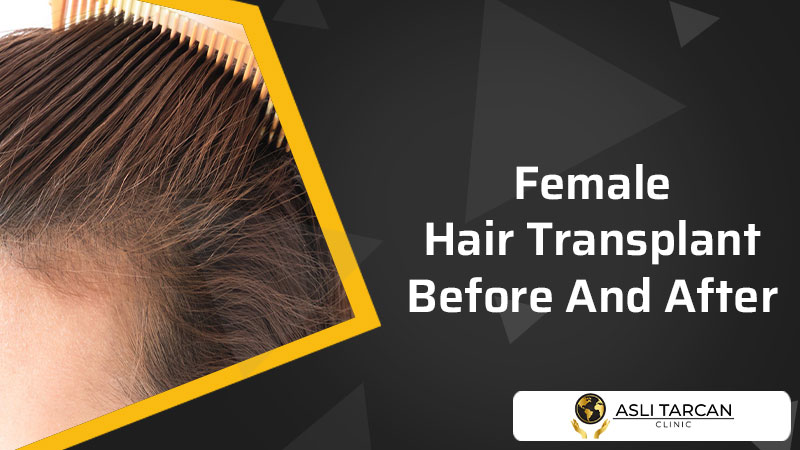 Female Hair Transplant Before And After | Asli Tarcan Clinic