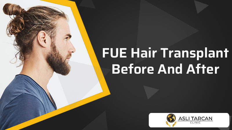FUE Hair Transplant Before And After