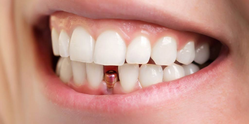 Full Dental Implants Treatment