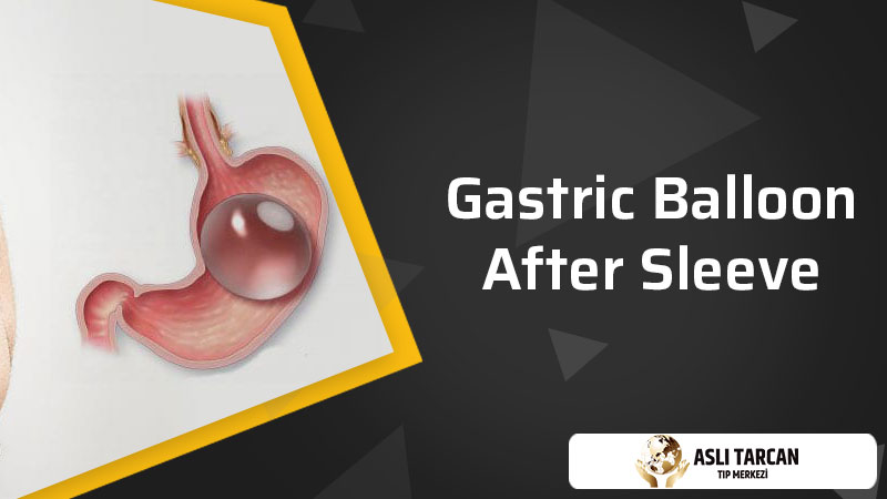 Gastric Balloon After Sleeve