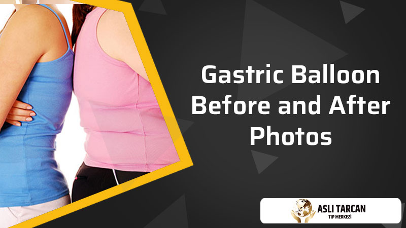 Gastric Balloon Before and After Photos