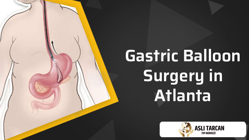 Gastric Balloon Surgery in Atlanta