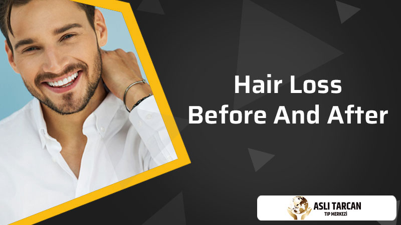 Hair Loss Before and After