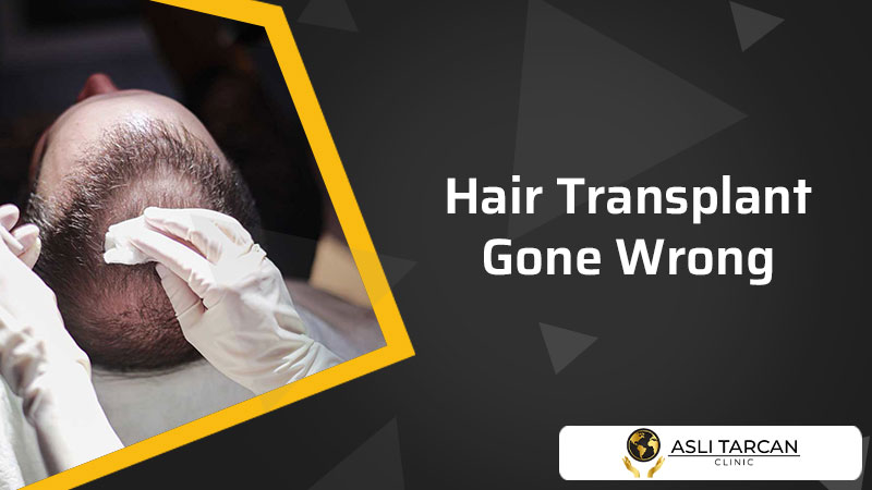 Hair Transplant Gone Wrong