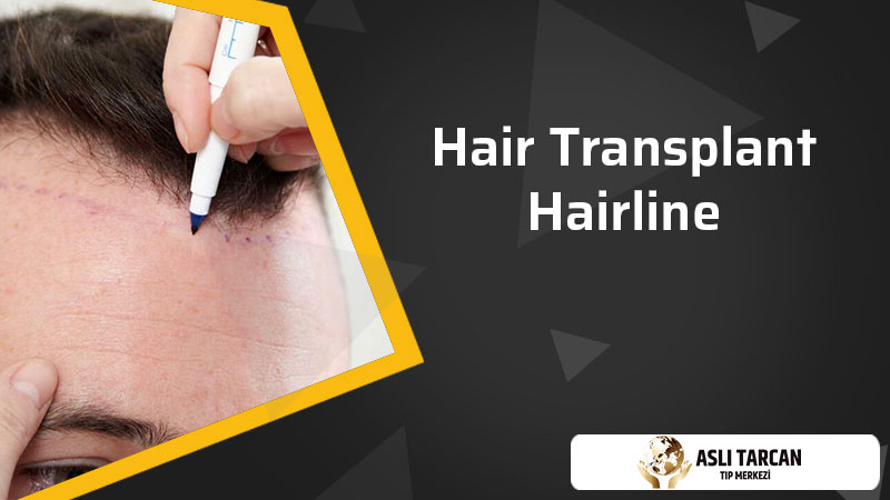 Hair Transplant Hairline