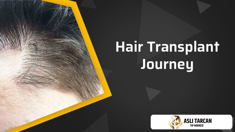 Hair Transplant Journey