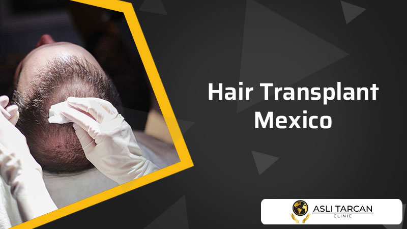 Hair Transplant Mexico