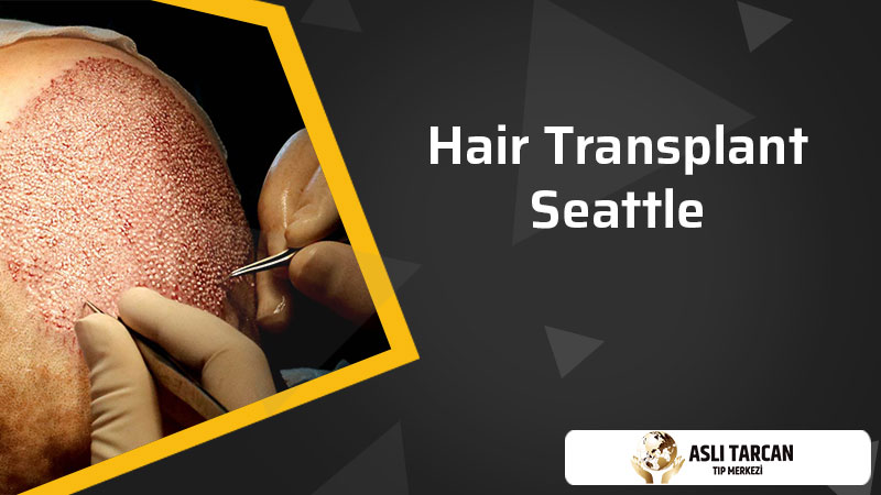 Hair Transplant Seattle