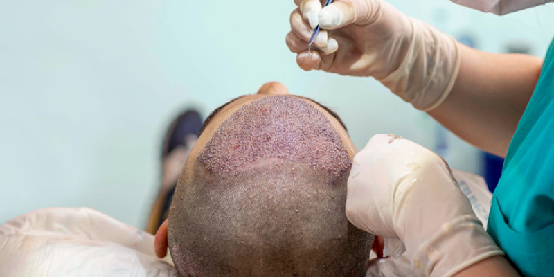 Hair Transplant Surgery Long Term Side Effects | Asli Tarcan Clinic