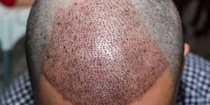 Hair Transplant Surgery Long Term Side Effects