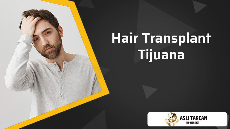 Hair Transplant Tijuana